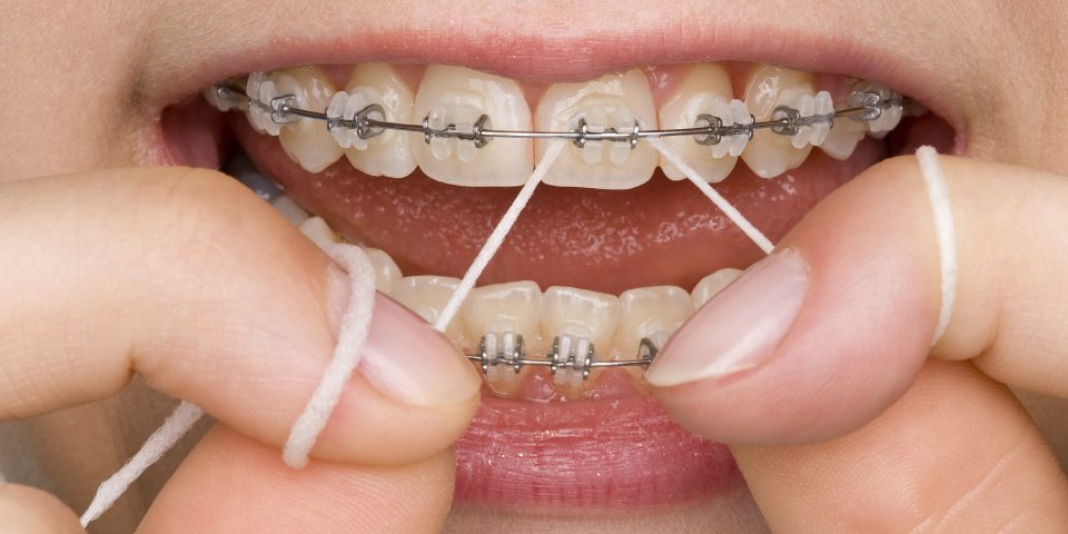 Flossing With Braces, How to Floss Teeth