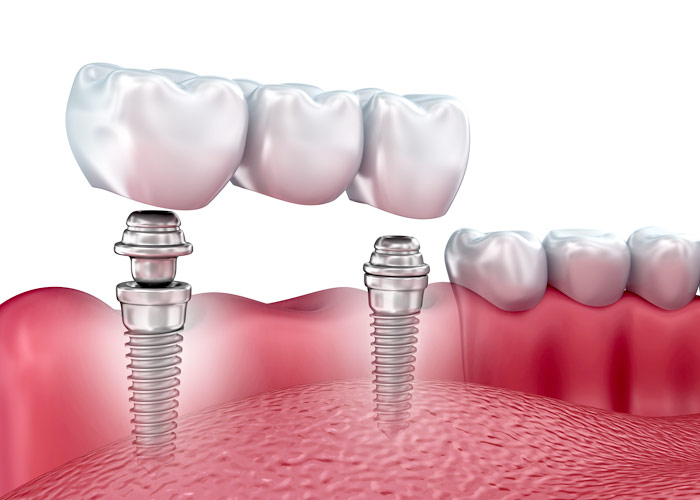Dental Implants – Implant bridge