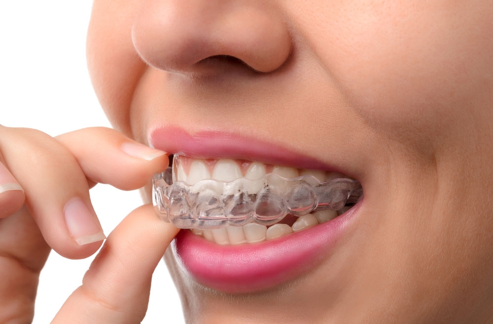 What is Clear Braces (Invisalign)